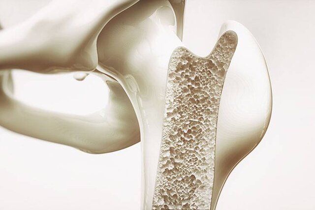 استئوپوروز