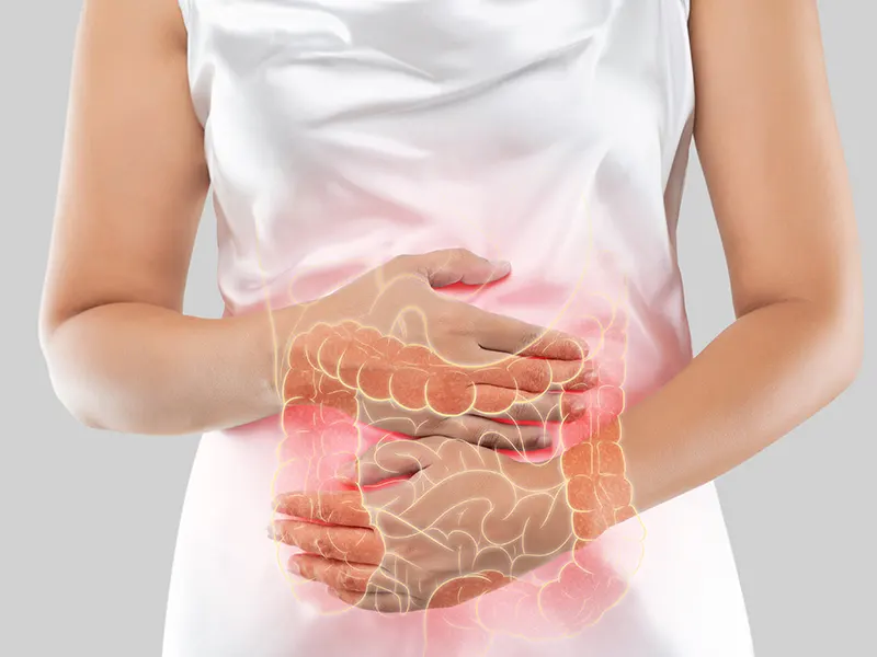 بیماری التهابی روده IBD