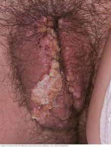 HPV