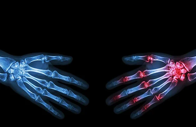 بیماری‌ های روماتولوژی