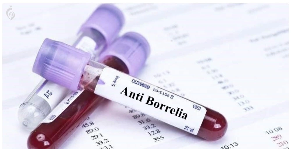 Anti-Borrelia (IgG)