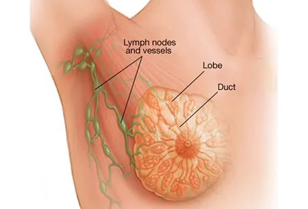 سرطان پستان