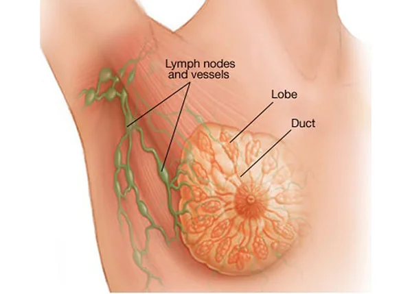 سرطان پستان