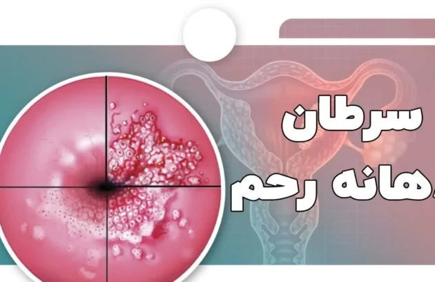 سرطان دهانه رحم
