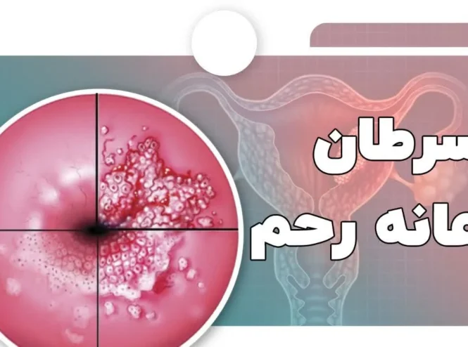 سرطان دهانه رحم