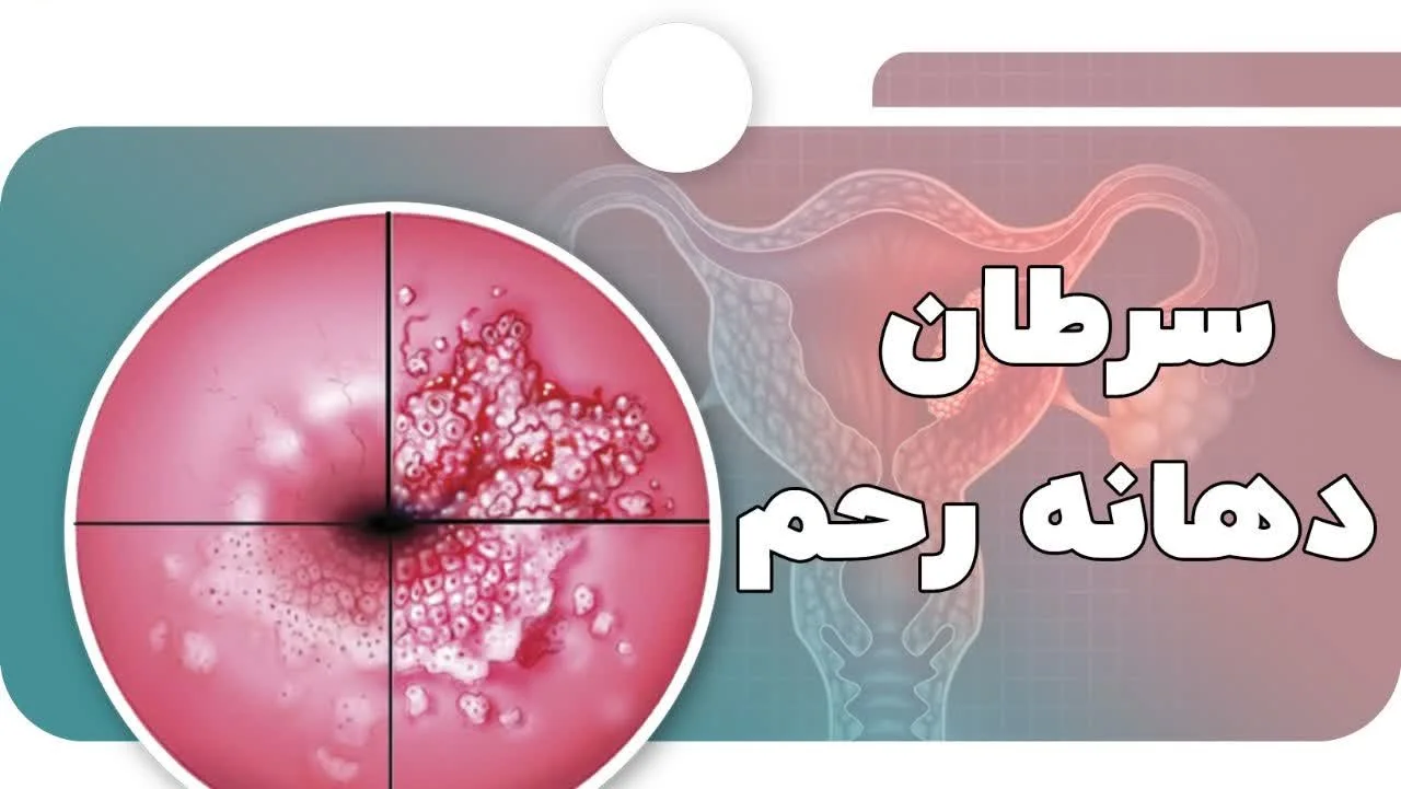 سرطان دهانه رحم
