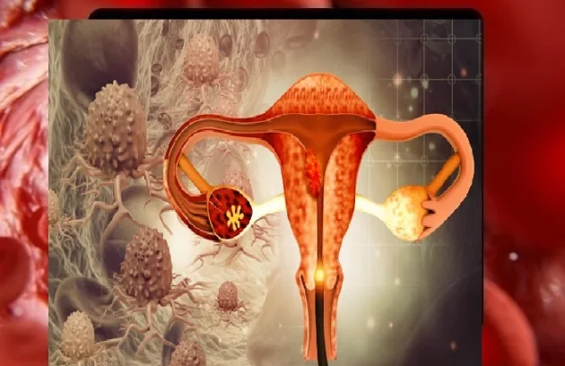 سرطان تخمدان