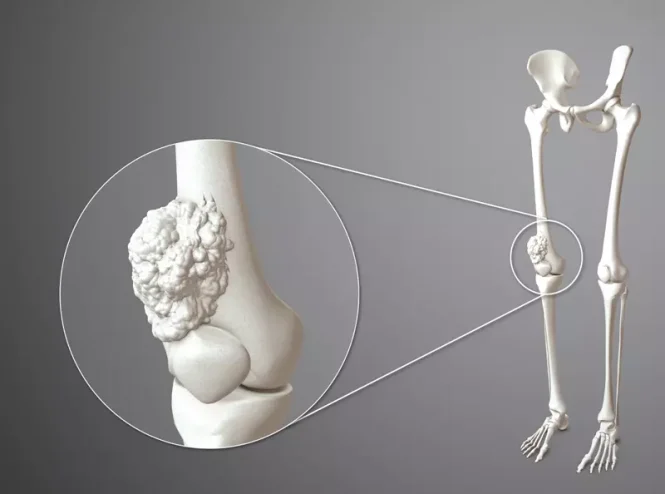 سرطان استخوان