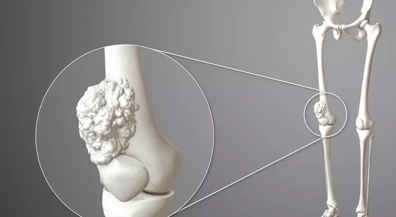 سرطان استخوان